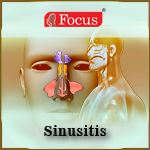 Sinusitis – An Overview Sinusitis – An Overview